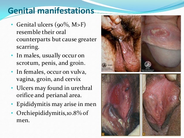 chrons disease vaginal Chrons disease vaginal
